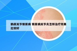 鹤叔关节银屑病 银屑病关节炎怎样治疗效果比较好