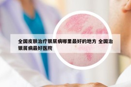 全国皮肤治疗银屑病哪里最好的地方 全国治银屑病最好医院