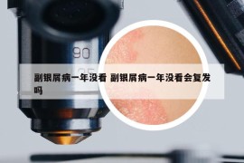 副银屑病一年没看 副银屑病一年没看会复发吗