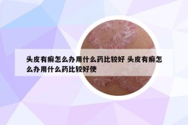 头皮有癣怎么办用什么药比较好 头皮有癣怎么办用什么药比较好使