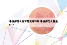 牛皮癣什么样算是见好转呢 牛皮癣怎么算是好了