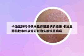 卡泊三醇和倍他米松在银屑病的应用 卡泊三醇倍他米松软膏可以治头部银屑病吗