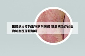 银屑病治疗的生物制剂医保 银屑病治疗的生物制剂医保报销吗