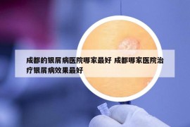 成都的银屑病医院哪家最好 成都哪家医院治疗银屑病效果最好