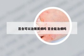 百合可以治银屑病吗 百合能治病吗