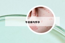 牛皮癣与怀孕