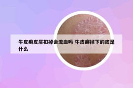 牛皮癣皮屑扣掉会流血吗 牛皮癣掉下的皮是什么
