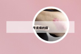 牛皮癣的藓