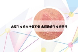 太原牛皮癣治疗贵不贵 太原治疗牛皮癜医院