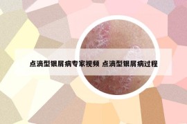 点滴型银屑病专家视频 点滴型银屑病过程