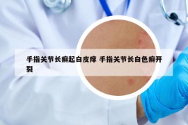 手指关节长癣起白皮痒 手指关节长白色癣开裂