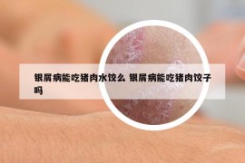 银屑病能吃猪肉水饺么 银屑病能吃猪肉饺子吗