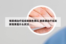 银屑病治疗后皮肤颜色黑红 银屑病治疗后皮肤变黑是什么状况