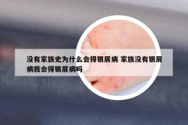 没有家族史为什么会得银屑病 家族没有银屑病我会得银屑病吗