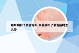 银屑病扣了会留疤吗 银屑病扣了会留疤吗怎么办