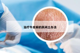 治疗牛皮癣的民间土办法