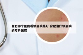 合肥哪个医院看银屑病最好 合肥治疗银屑病的专科医院