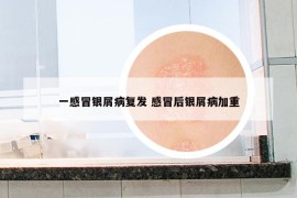 一感冒银屑病复发 感冒后银屑病加重