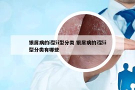 银屑病的i型ii型分类 银屑病的i型ii型分类有哪些
