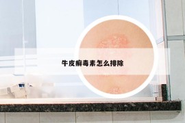 牛皮癣毒素怎么排除