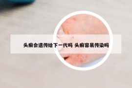 头癣会遗传给下一代吗 头癣容易传染吗