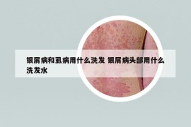 银屑病和虱病用什么洗发 银屑病头部用什么洗发水