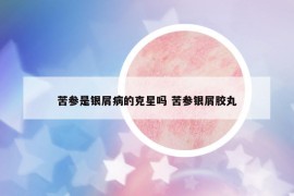 苦参是银屑病的克星吗 苦参银屑胶丸
