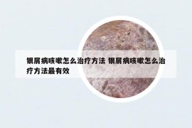银屑病咳嗽怎么治疗方法 银屑病咳嗽怎么治疗方法最有效