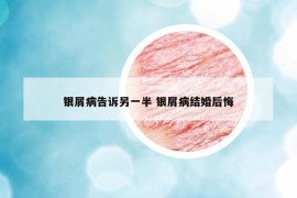 银屑病告诉另一半 银屑病结婚后悔
