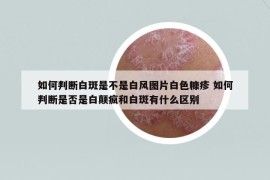 如何判断白斑是不是白风图片白色糠疹 如何判断是否是白颠疯和白斑有什么区别