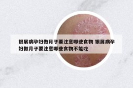 银屑病孕妇做月子要注意哪些食物 银屑病孕妇做月子要注意哪些食物不能吃