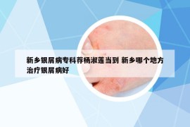 新乡银屑病专科荐杨淑莲当到 新乡哪个地方治疗银屑病好