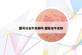 醋可以治牛皮癣吗 醋能治牛皮鲜