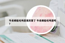 牛皮癣能吃鸡蛋更厉害了 牛皮癣能吃鸡蛋吗?