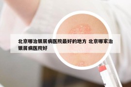 北京哪治银屑病医院最好的地方 北京哪家治银屑病医院好
