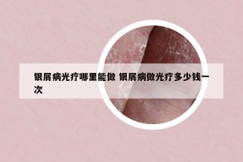 银屑病光疗哪里能做 银屑病做光疗多少钱一次