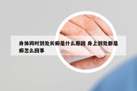 身体同时到处长癣是什么原因 身上到处都是癣怎么回事