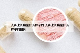 人身上长癣是什么样子的 人身上长癣是什么样子的图片