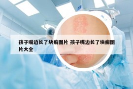 孩子嘴边长了块癣图片 孩子嘴边长了块癣图片大全