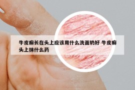 牛皮癣长在头上应该用什么洗面奶好 牛皮癣头上抹什么药
