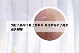 为什么怀孕了身上会长癣 为什么怀孕了身上会长癣痒