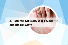 身上起癣是什么原因引起的 身上起癣是什么原因引起的怎么治疗