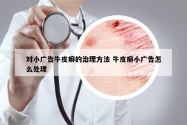 对小广告牛皮癣的治理方法 牛皮癣小广告怎么处理