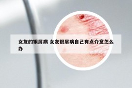 女友的银屑病 女友银屑病自己有点介意怎么办