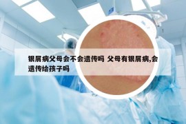 银屑病父母会不会遗传吗 父母有银屑病,会遗传给孩子吗