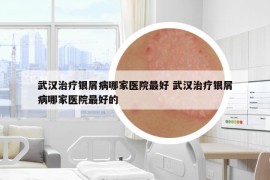 武汉治疗银屑病哪家医院最好 武汉治疗银屑病哪家医院最好的