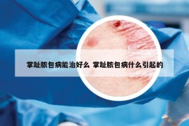 掌趾脓包病能治好么 掌趾脓包病什么引起的
