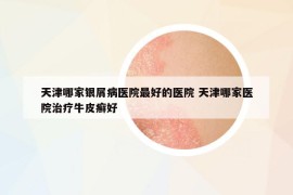 天津哪家银屑病医院最好的医院 天津哪家医院治疗牛皮癣好