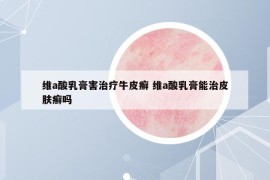 维a酸乳膏害治疗牛皮癣 维a酸乳膏能治皮肤癣吗