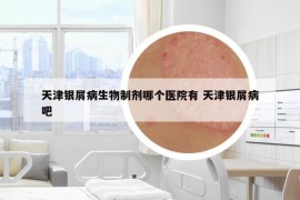 天津银屑病生物制剂哪个医院有 天津银屑病吧